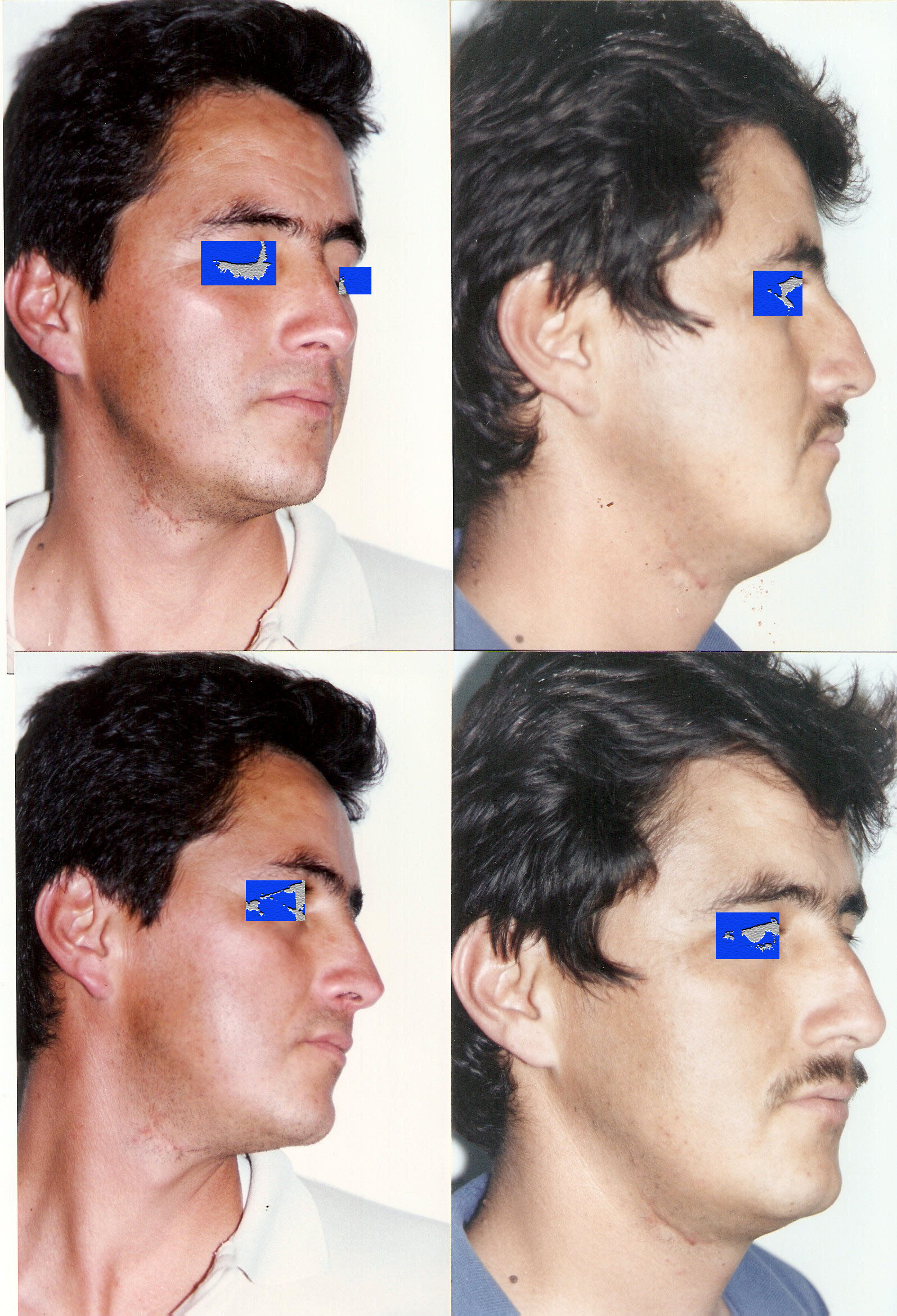 Resultado Rinoplastia 3