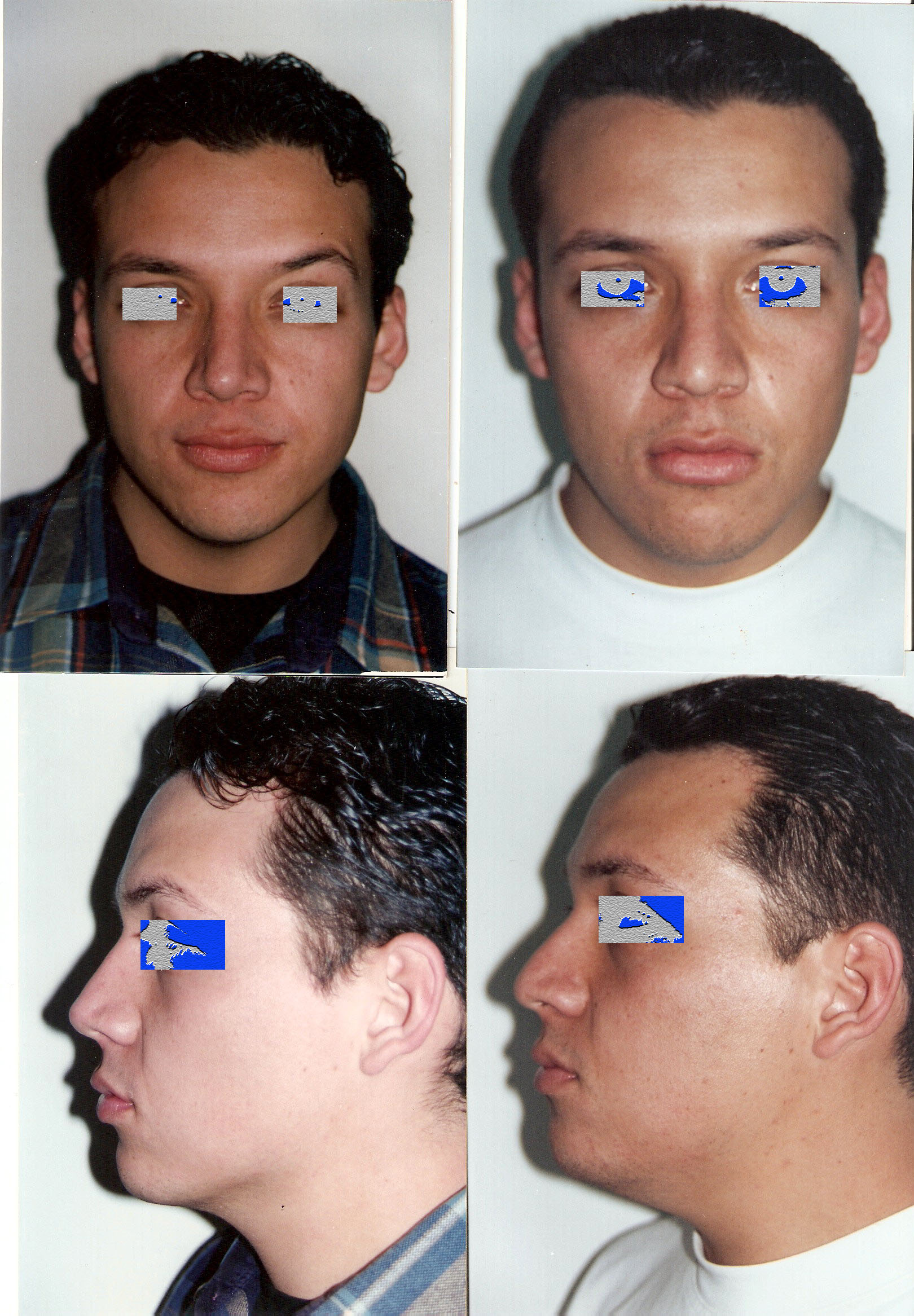 Resultado Rinoplastia 4